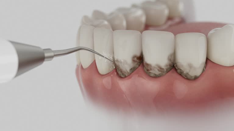 Trusted Wisdom Tooth Removal service in Napoleon, OH - Dentist Open Now